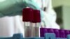 With AIDS, 2017 Saw One Step Closer to the End