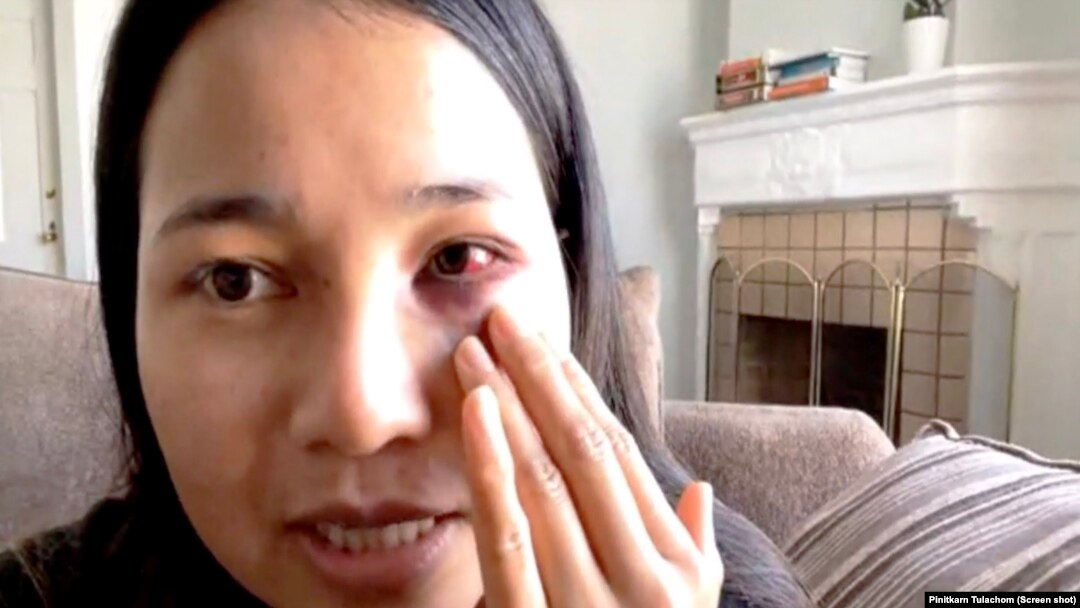 Mantakarn Seenin, A Thai woman shows her wounds on her face cause by brutally attacked while riding the BART train in San Francisco, CA. 