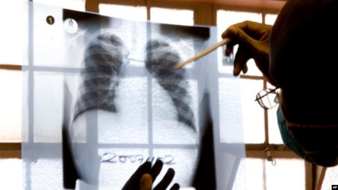 FILE - A doctor examines chest X-rays at a tuberculosis clinic in Cape Town, South Africa. 